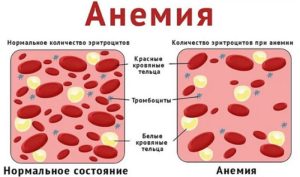 Анемия при диабете - причины и осложнения